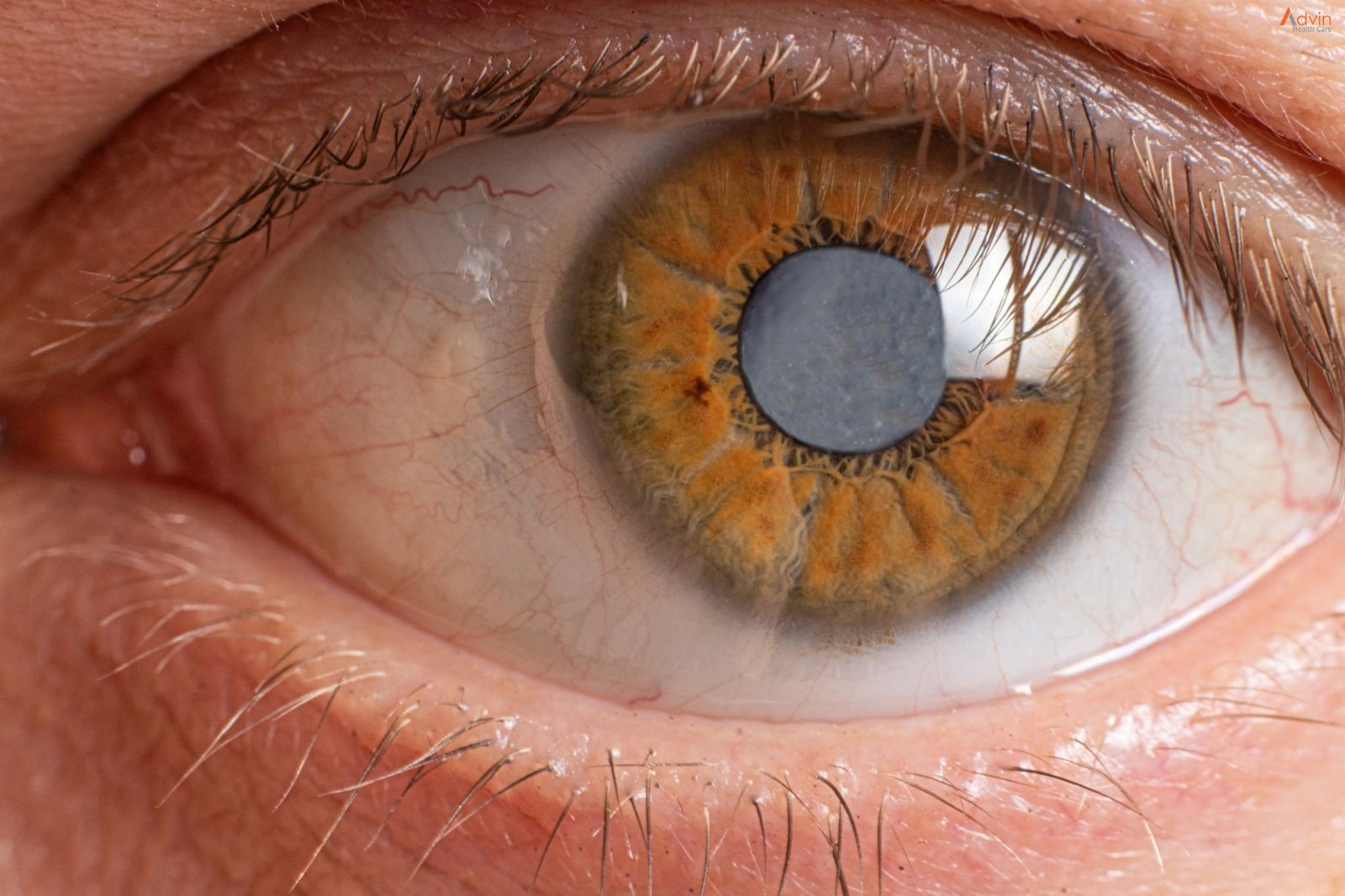 Glaucoma Treatment Kurukshetra
